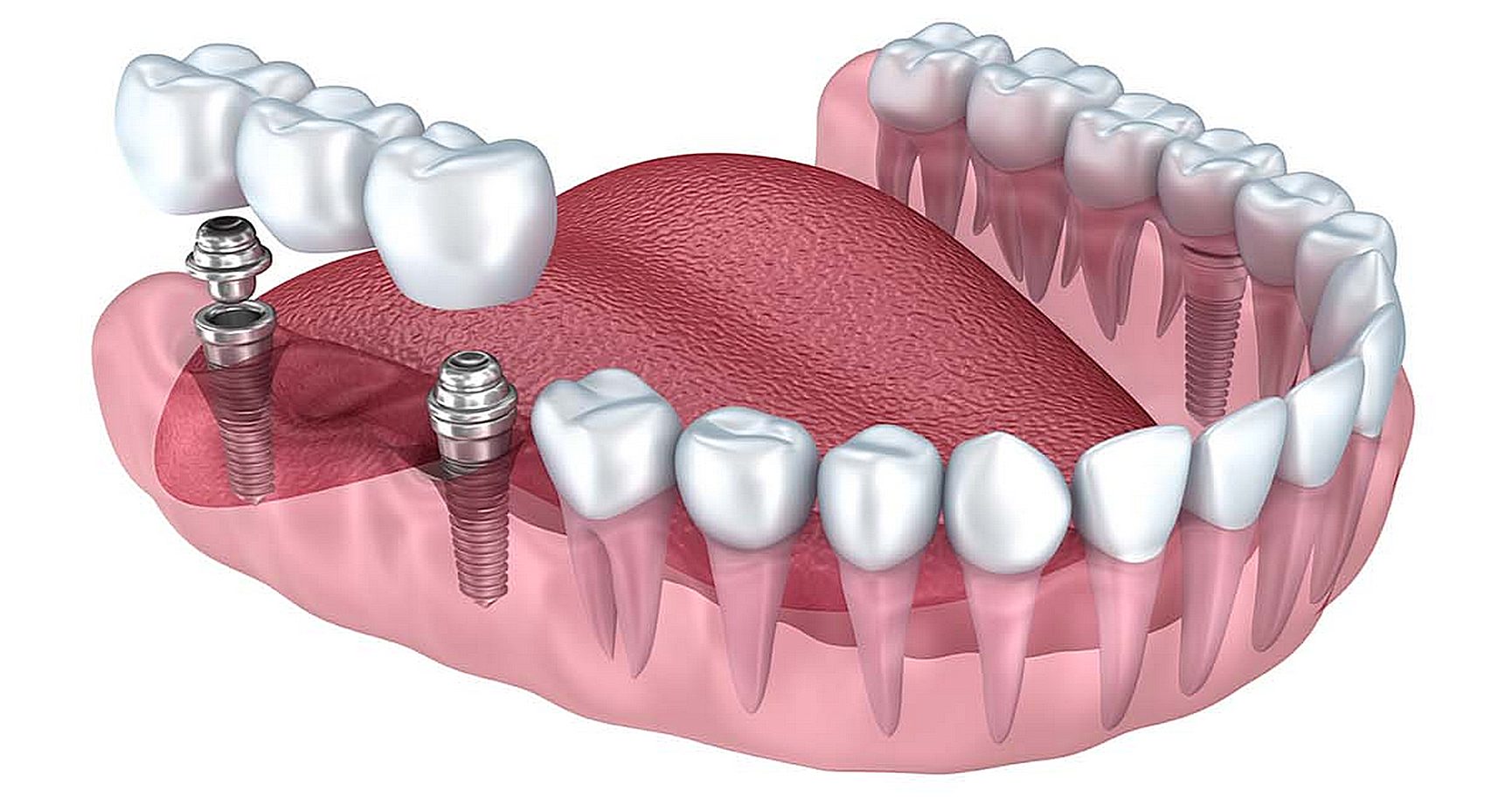 Имплантация зубов под ключ: секрет долговечной улыбки